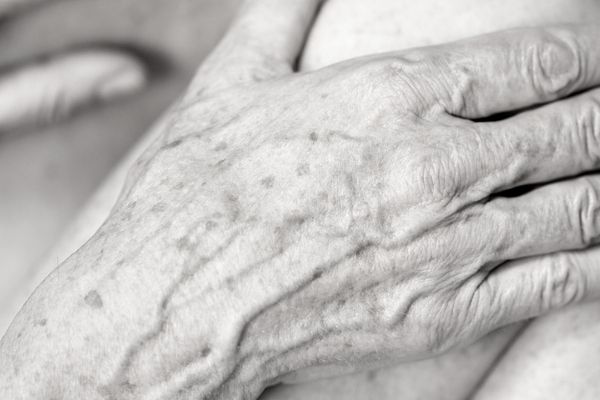 Age Spots removal on the hands by cryosonic Hythe