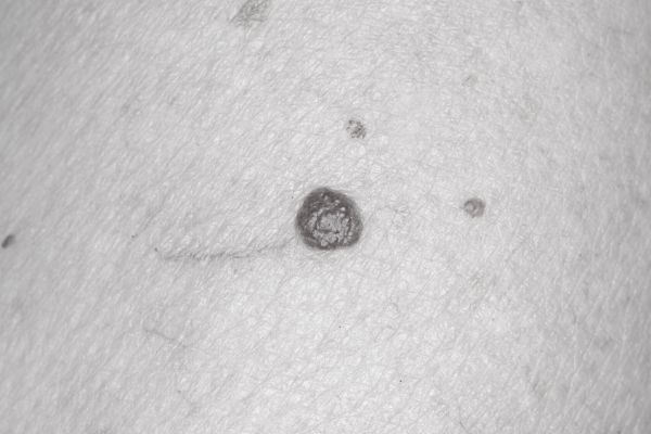 Cherry Angioma Post-Treatment Care for Best Results Hythe