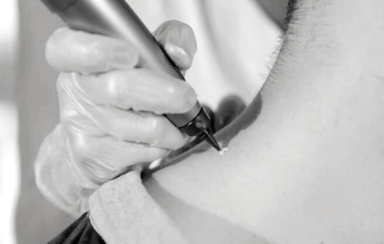 Benign Mole Possible Reactions and How Common They Are Hythe
