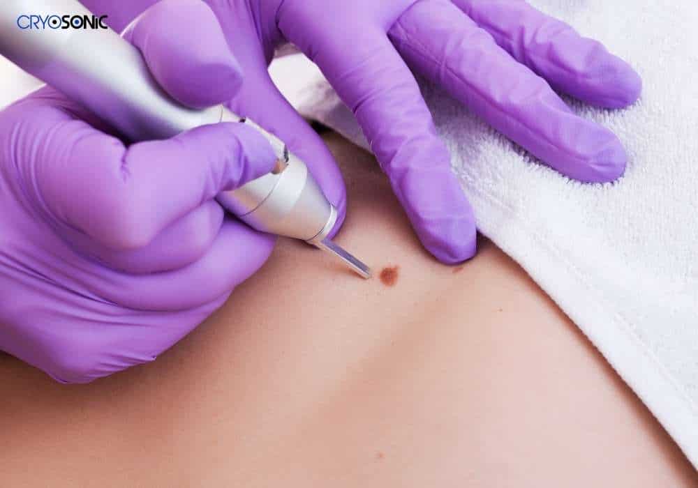 Cryopen Treatment Hythe Hythe