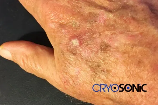 Book Your Actinic Keratosis removal Hythe treatment Today Hythe