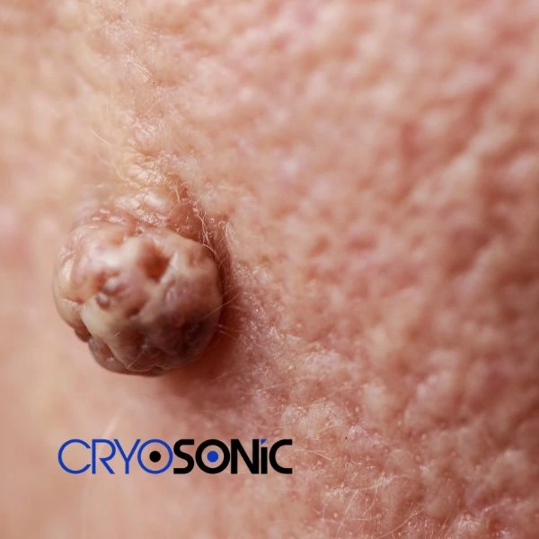Book your Dermatofibroma removal today Hythe