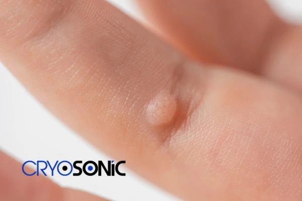 Contact Cryosonic today to learn more about us Hythe now! Hythe