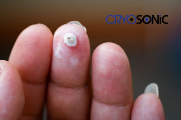 Learn more about us Hythe at Cryosonic. Book in today! Hythe