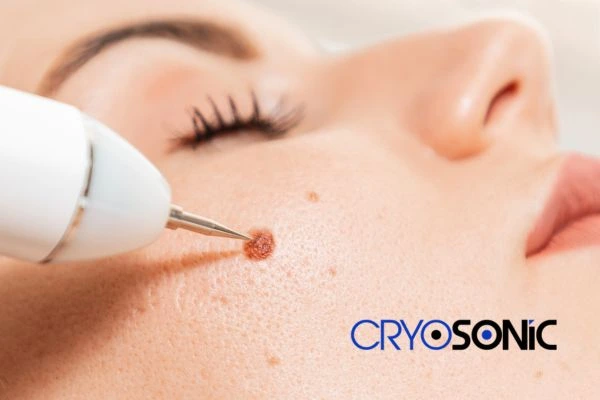 why choose us at Cryosonic for blemish removal? Find out more now Hythe