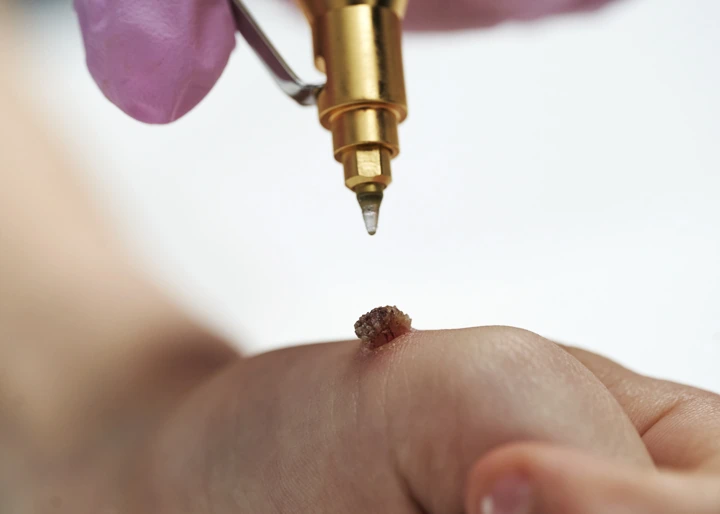 Cryopen For Children Bristol Hythe