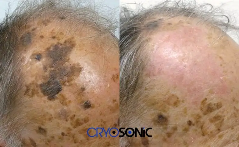 Seborrhoeic Keratosis Removal before and after Hythe
