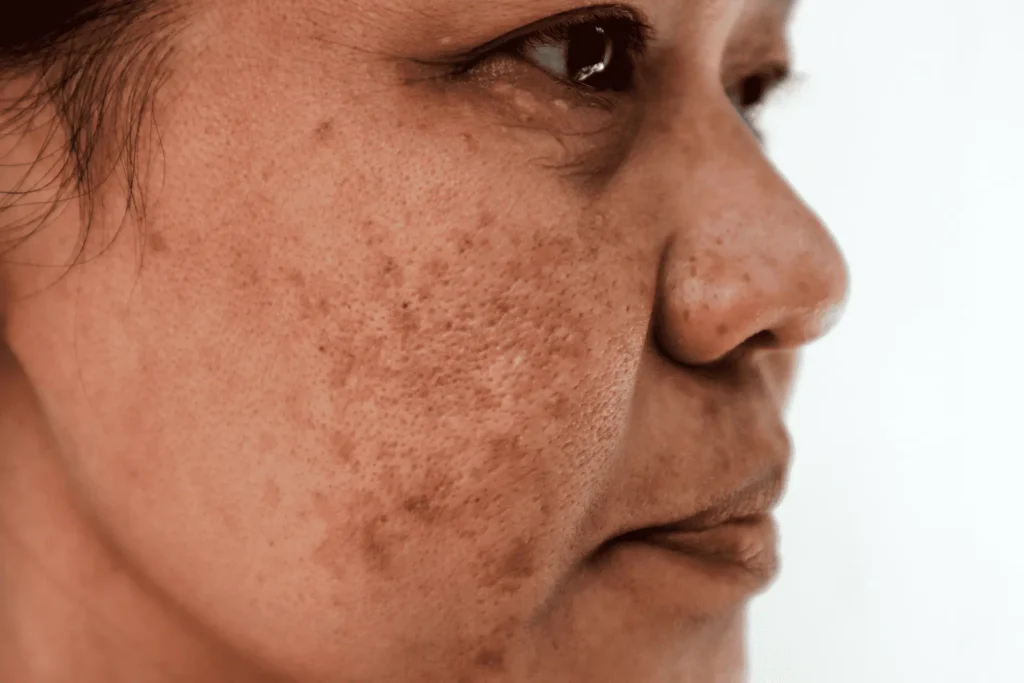 Aftercare Advice for Sun Damage Treatment Hythe