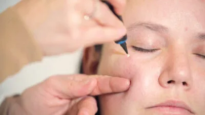 Aftercare Advice Following Milia Removal in Hythe