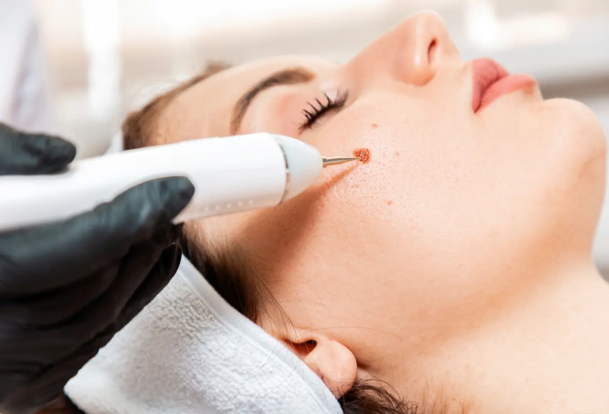 Frequently Asked Questions About Multiple Cryotherapy Treatments Hythe