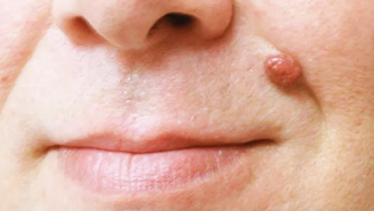Are There Any Side Effects After removing the Skin Tags? Hythe