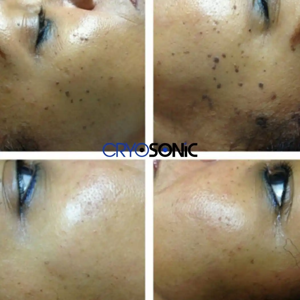 Why Skin Shows Pigmentation After Treatment Hythe