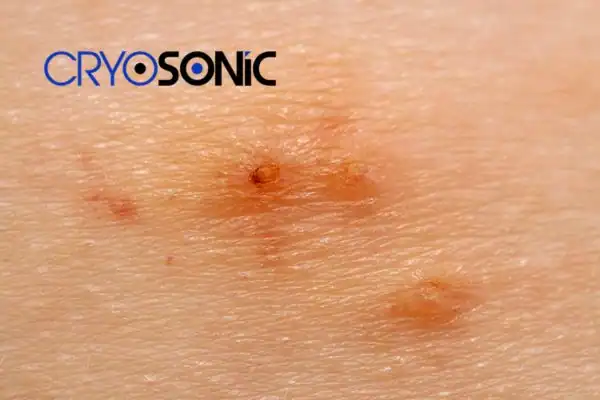Image of Molluscum Contagiosum Treatment Hythe Hythe