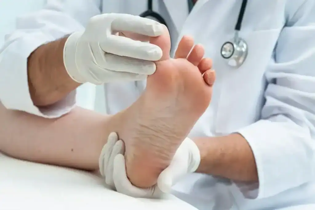 Porokeratosis Removal Treatment Hythe