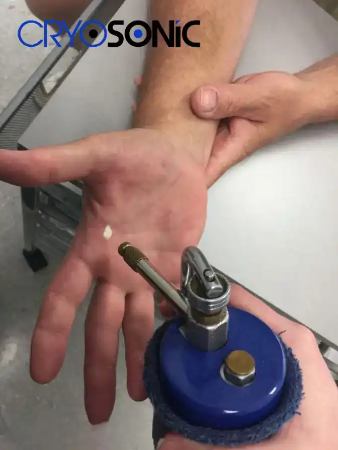 Temperature Differences: OTC vs Medical-Grade Cryotherapy Hythe